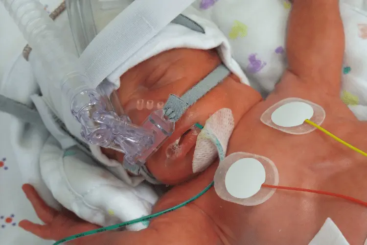 Dysplazja oskrzelowo-płucna (BPD) – aktualne wytyczne i decyzje kliniczne 